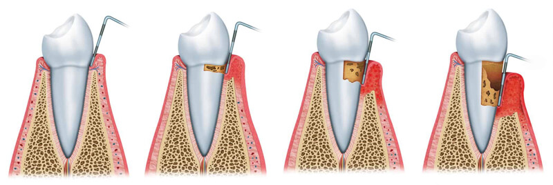Periodontology Stages of Gum Disease