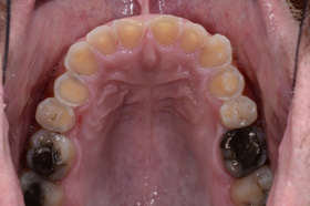 Severe Tooth Wear due to Attrition (physical wear)