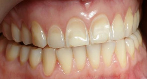 Tooth Wear due to Aggressive Tooth Brushing Trauma (Abrasion)